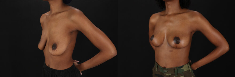 Breast Lift case #7806