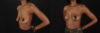 Breast Lift case #7806 slider thumbnail