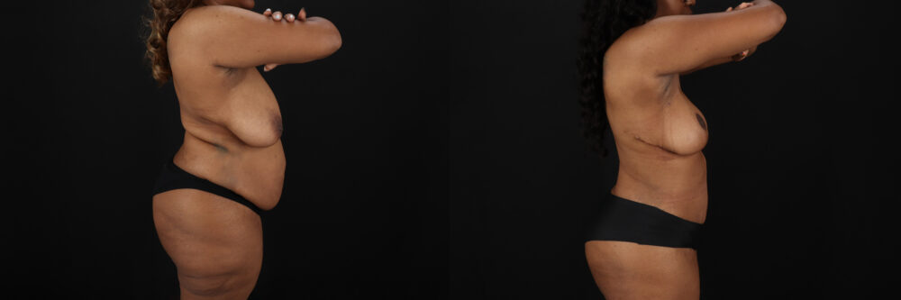 Post Bariatric Surgery (Massive Weight Loss) case #6782