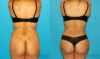 Tummy Tuck case #7340 slider thumbnail