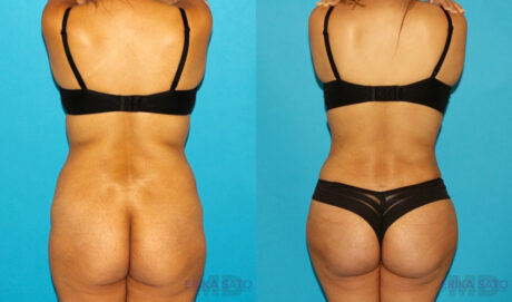 Tummy Tuck case #7340