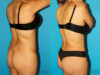 Tummy Tuck case #7340 slider thumbnail