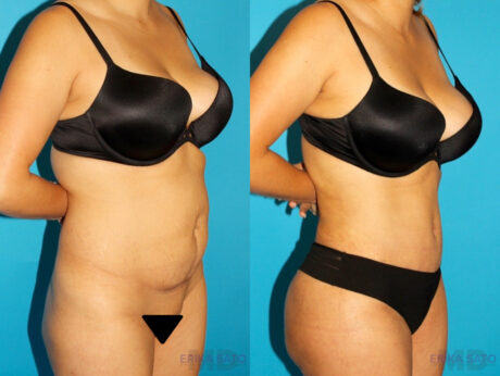 Tummy Tuck case #7340