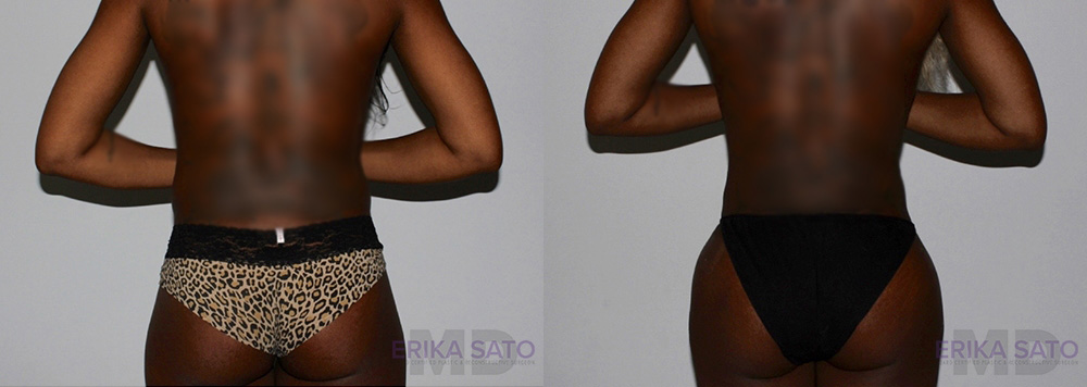 Brazilian Butt Lift case #4417