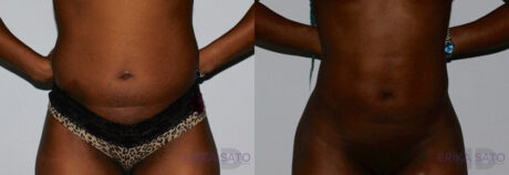 Brazilian Butt Lift case #4417