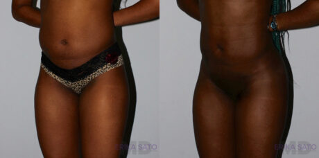 Brazilian Butt Lift case #4417