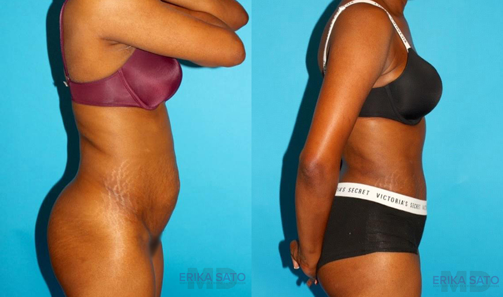 Tummy Tuck case #7275