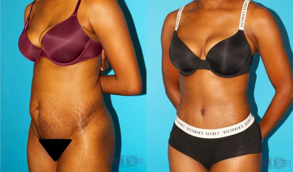 Tummy Tuck case #7275