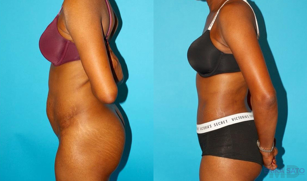 Tummy Tuck case #7275