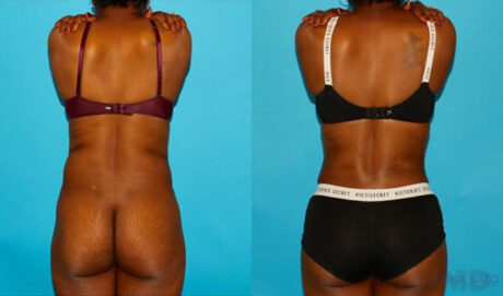 Tummy Tuck case #7275