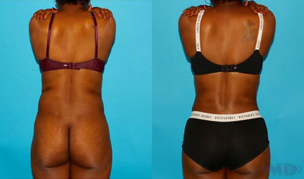 Tummy Tuck case #7275