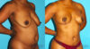 Breast Lift case #6994 slider thumbnail