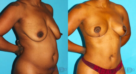 Breast Lift case #6994