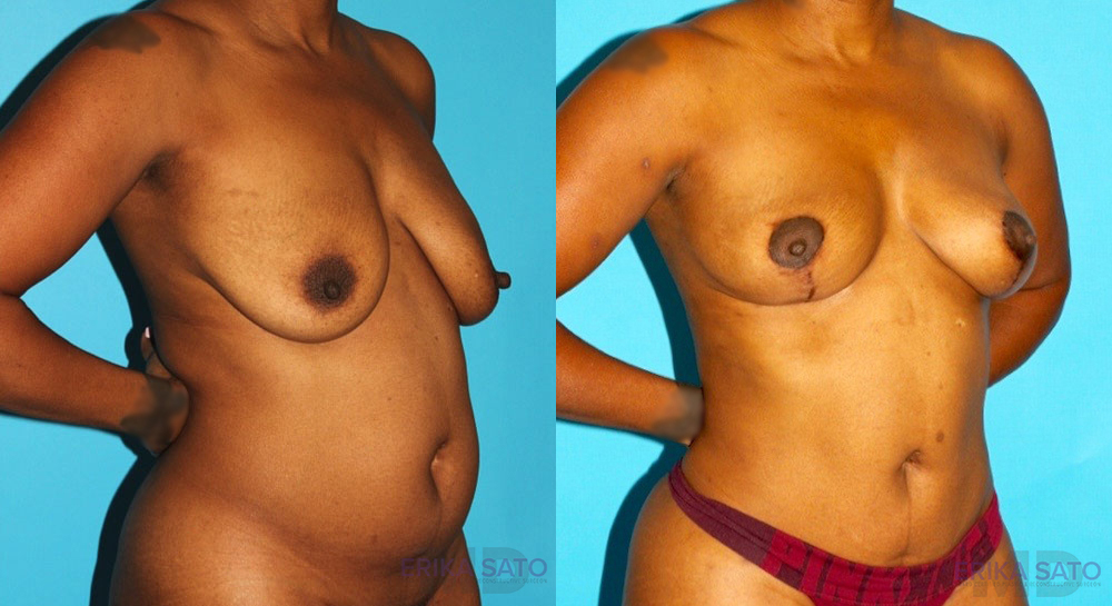 Breast Lift case #6994