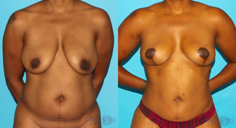 Breast Lift case #6994