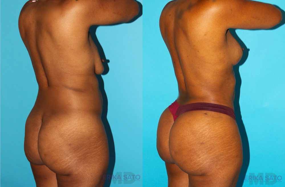 Brazilian Butt Lift case #4605