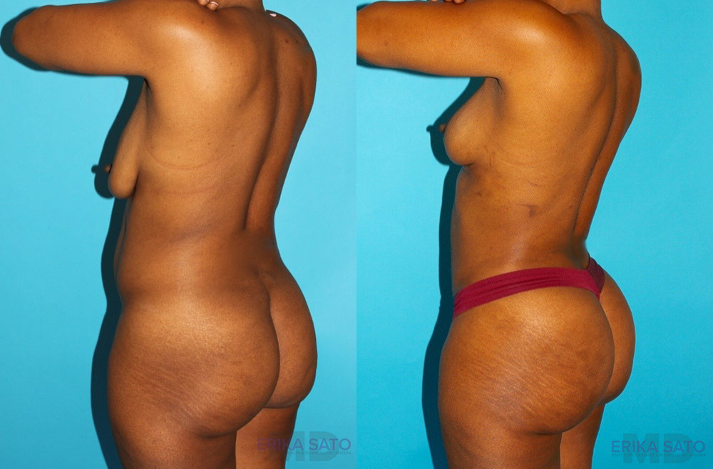 Brazilian Butt Lift case #4605