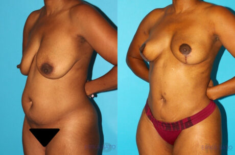 Brazilian Butt Lift case #4605