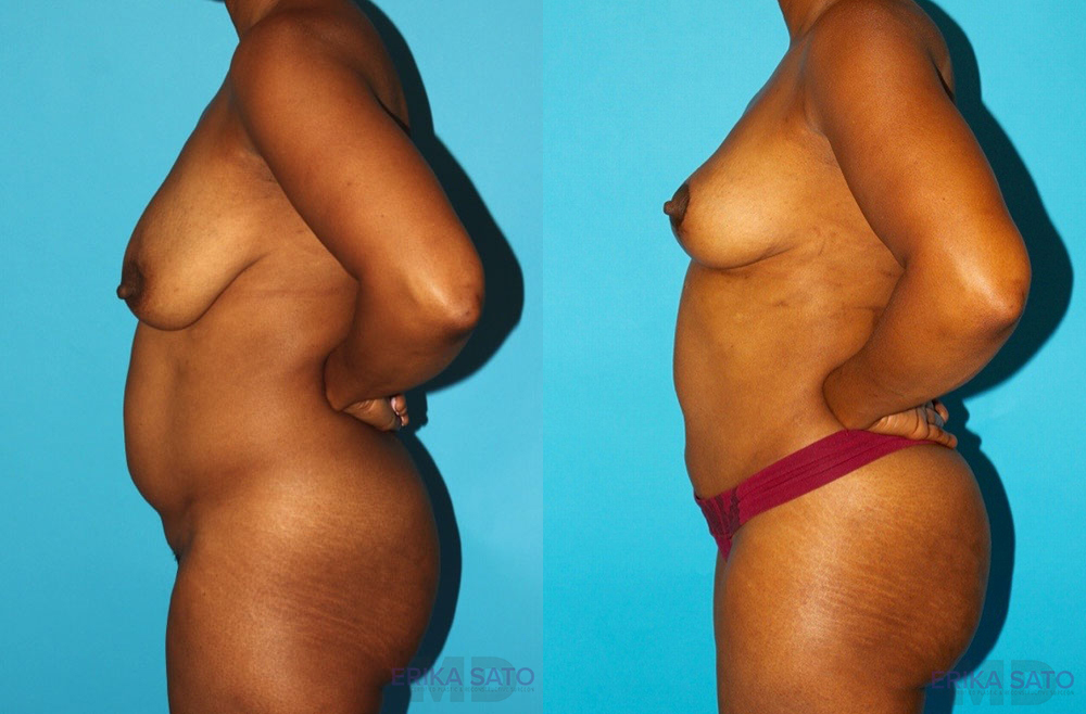 Brazilian Butt Lift case #4605