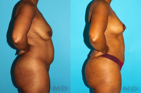 Brazilian Butt Lift case #4605