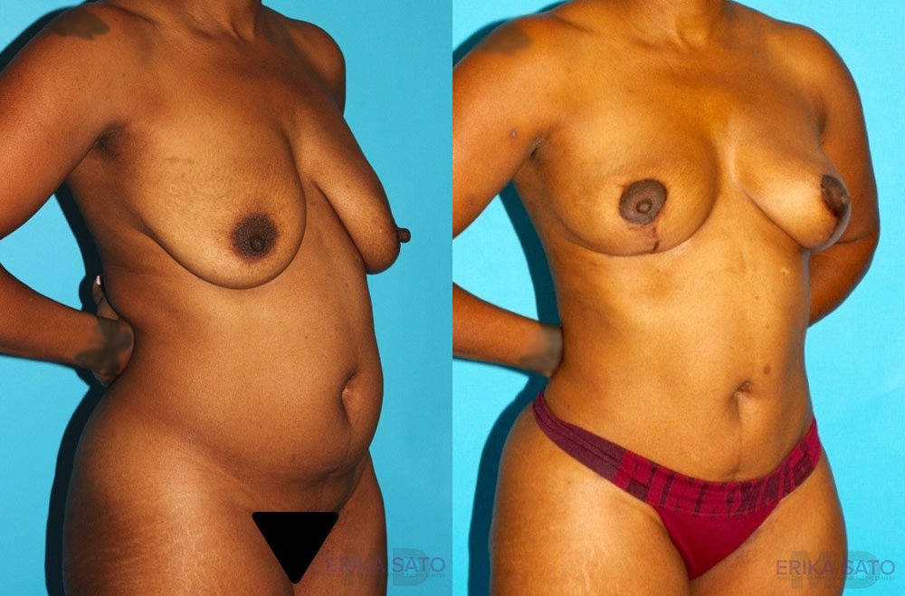 Brazilian Butt Lift case #4605