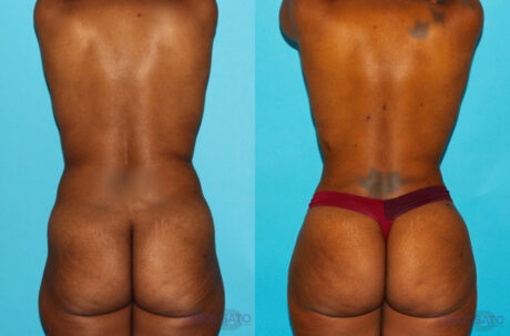 Brazilian Butt Lift case #4605