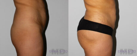 Brazilian Butt Lift case #4408