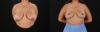 Breast Reduction case #8018 slider thumbnail