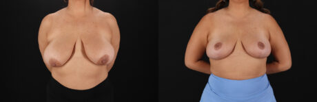 Breast Reduction case #8018