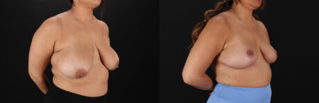 Breast Reduction case #8018
