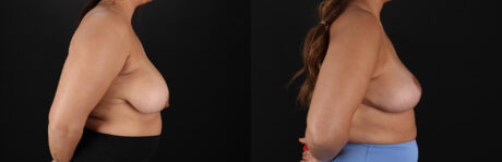 Breast Reduction case #8018
