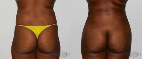 Brazilian Butt Lift case #4724