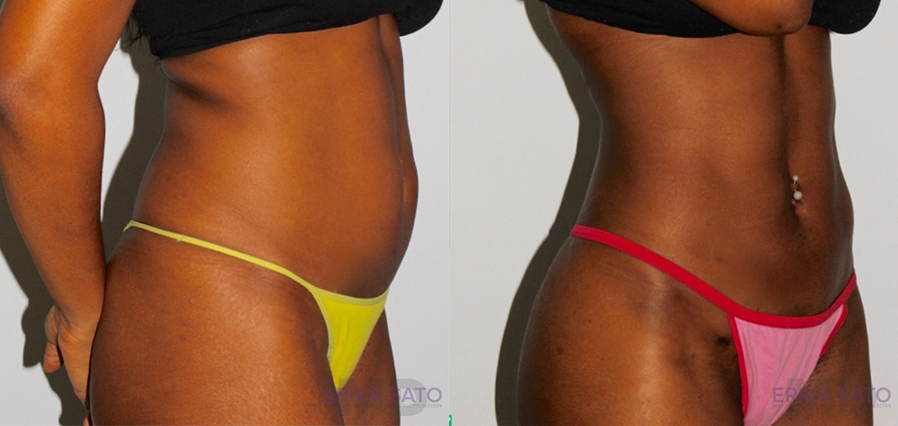 Brazilian Butt Lift case #4724