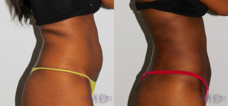 Brazilian Butt Lift case #4724