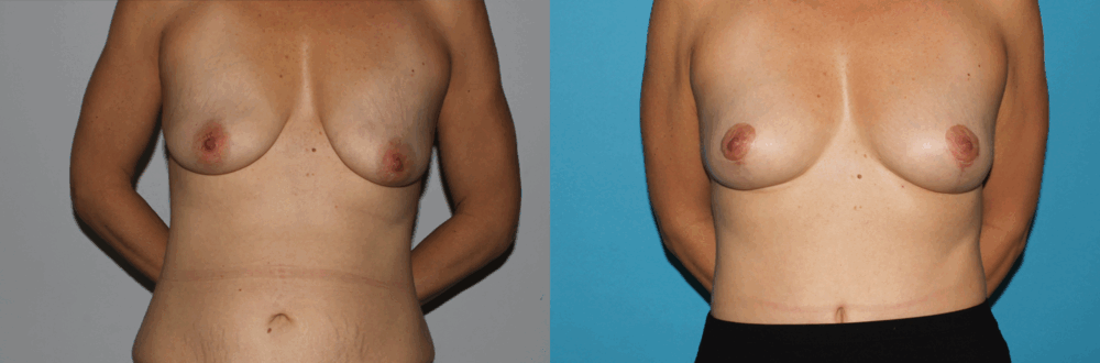 Breast Lift case #6939