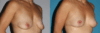 Breast Lift case #6939 slider thumbnail