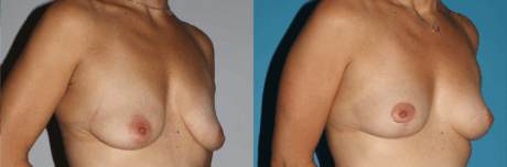 Breast Lift case #6939