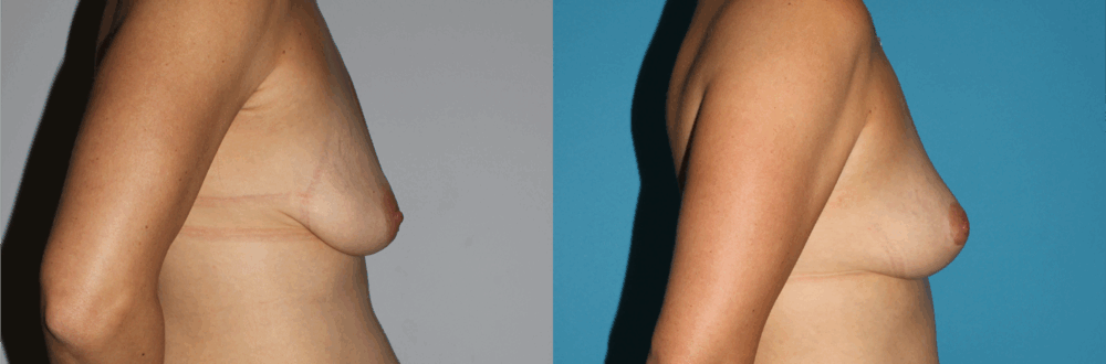 Breast Lift case #6939