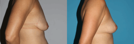 Breast Lift case #6939