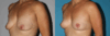 Breast Lift case #6939 slider thumbnail