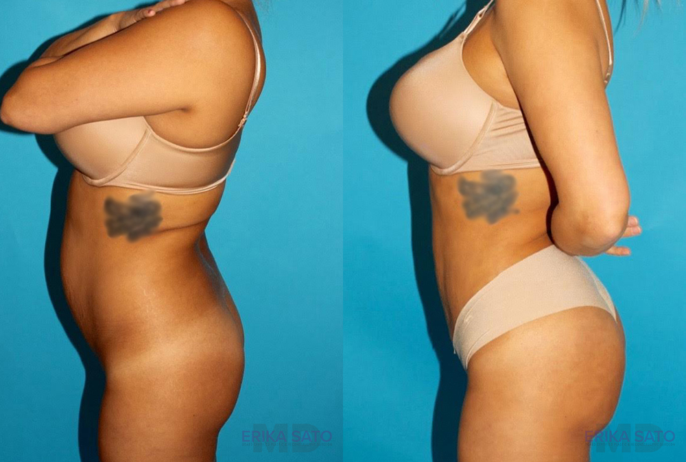 Brazilian Butt Lift case #4616