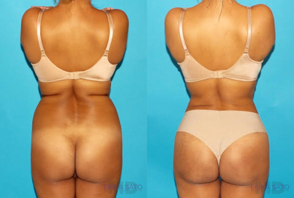 Brazilian Butt Lift case #4616