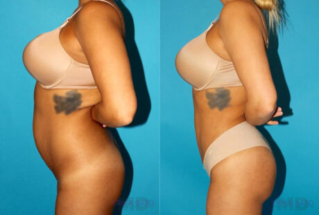 Brazilian Butt Lift case #4616