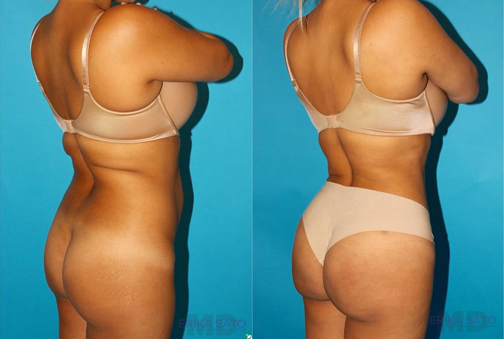 Brazilian Butt Lift case #4616