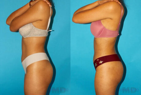 Brazilian Butt Lift case #4767