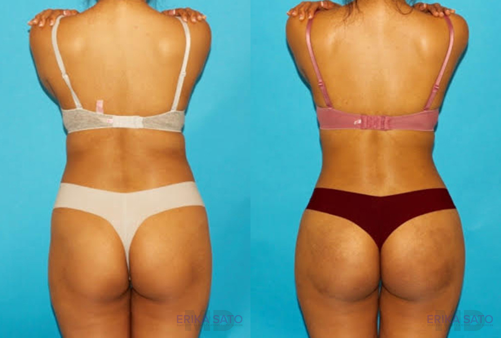 Brazilian Butt Lift case #4767