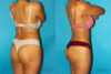 Brazilian Butt Lift case #4767 slider thumbnail