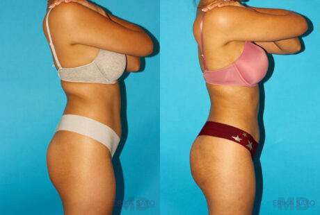 Brazilian Butt Lift case #4767