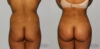 Brazilian Butt Lift case #4478 slider thumbnail