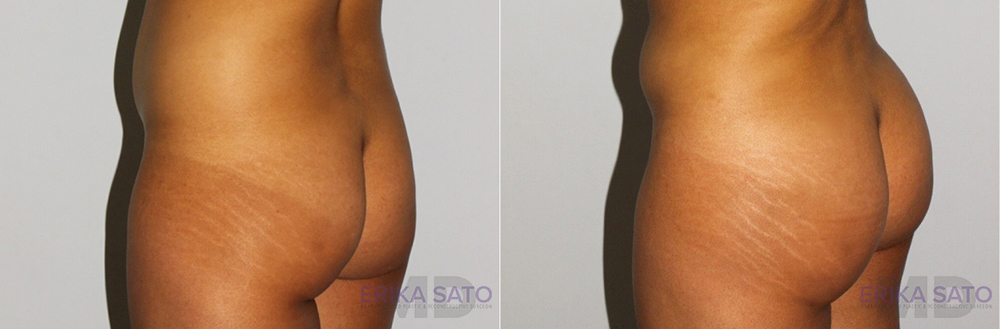 Brazilian Butt Lift case #4478